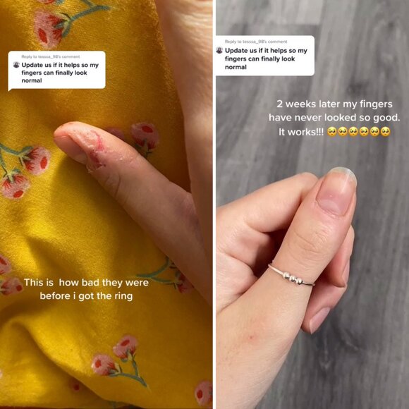 Fidget Beads Ring For Anxiety 💕 - Picture 9 of 12